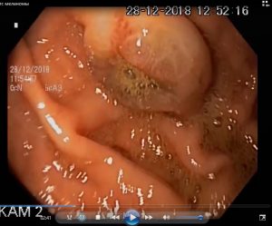 Метастаз меланомы в желудке